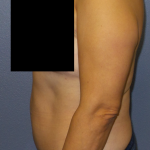 Abdominoplasty Before & After Patient #2102