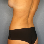 Liposuction Female Before & After Patient #1235