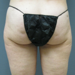 Liposuction Female Before & After Patient #1205