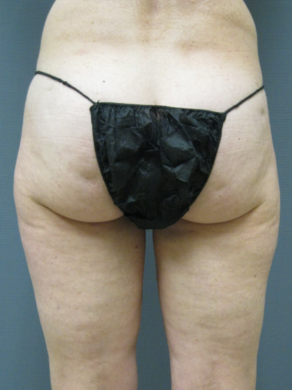 Liposuction Female Before & After Patient #1205