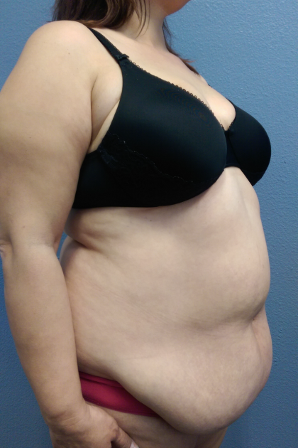 Abdominoplasty Before & After Patient #2102