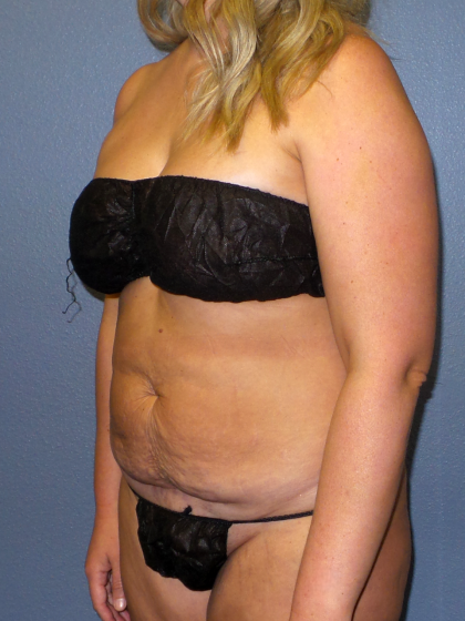 Abdominoplasty Before & After Patient #2156
