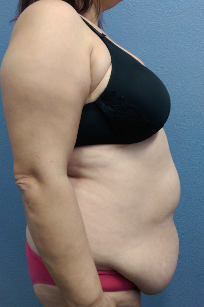 Abdominoplasty Before & After Patient #2102