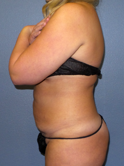 Abdominoplasty Before & After Patient #2156