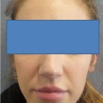 Filler Before & After Patient #2250