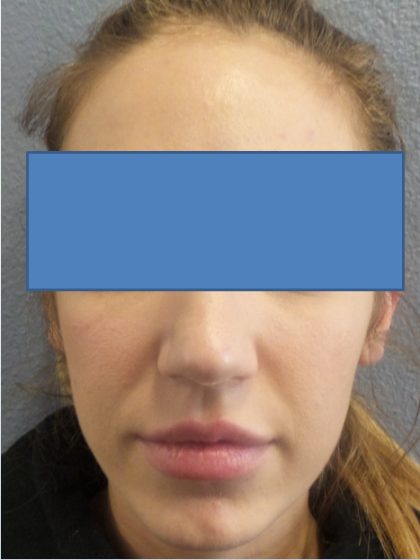 Filler Before & After Patient #2250