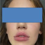 Filler Before & After Patient #2250