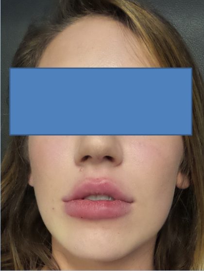 Filler Before & After Patient #2250