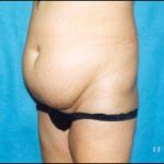 Abdominoplasty Before & After Patient #2406