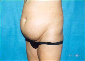 Abdominoplasty Before & After Patient #2406