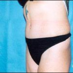 Abdominoplasty Before & After Patient #2406