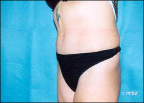 Abdominoplasty Before & After Patient #2406