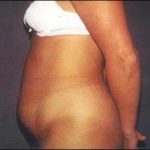 Abdominoplasty Before & After Patient #2407
