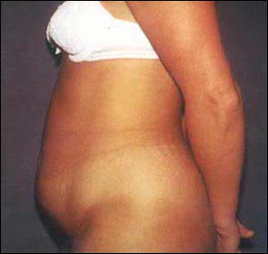Abdominoplasty Before & After Patient #2407