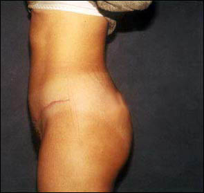 Abdominoplasty Before & After Patient #2407