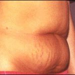 Abdominoplasty Before & After Patient #2408
