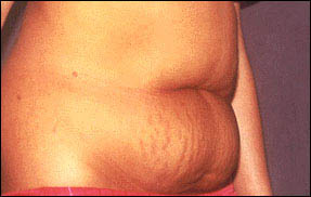 Abdominoplasty Before & After Patient #2408