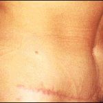 Abdominoplasty Before & After Patient #2408
