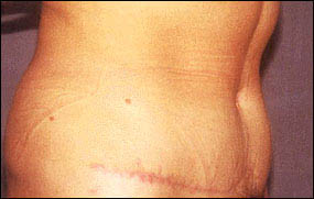 Abdominoplasty Before & After Patient #2408
