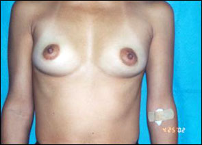 Breast Augmentation Before & After Patient #2425