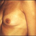 Breast Augmentation Before & After Patient #2427