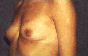 Breast Augmentation Before & After Patient #2427