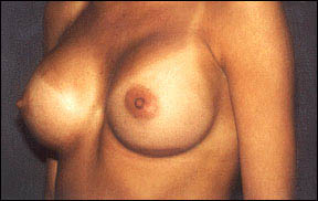 Breast Augmentation Before & After Patient #2427