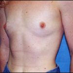 Breast Augmentation Before & After Patient #2428
