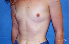 Breast Augmentation Before & After Patient #2428