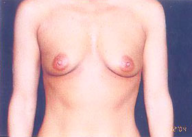 Breast Augmentation Before & After Patient #2437