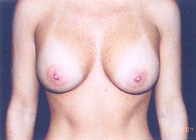 Breast Augmentation Before & After Patient #2437