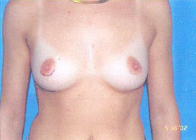 Breast Augmentation Before & After Patient #2438
