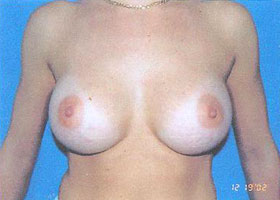 Breast Augmentation Before & After Patient #2438