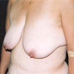 Breast Reduction Before & After Patient #2440