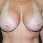 Breast Augmentation Before & After Patient #2418