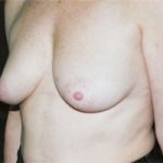 Breast Augmentation Before & After Patient #2418