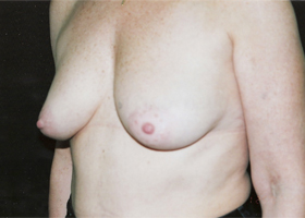 Breast Augmentation Before & After Patient #2418