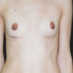Breast Augmentation Before & After Patient #2420