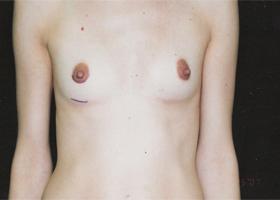 Breast Augmentation Before & After Patient #2420