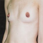 Breast Augmentation Before & After Patient #2420