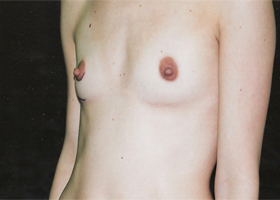 Breast Augmentation Before & After Patient #2420