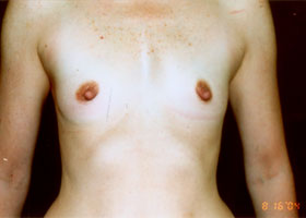Breast Augmentation Before & After Patient #2432