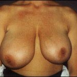 Breast Reduction Before & After Patient #2442
