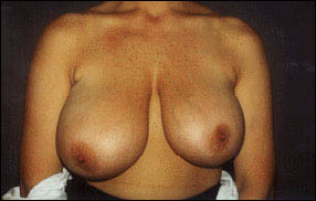 Breast Reduction Before & After Patient #2442