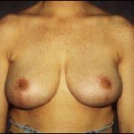 Breast Reduction Before & After Patient #2442