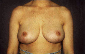 Breast Reduction Before & After Patient #2442