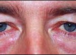 Blepharoplasty Before & After Patient #2453