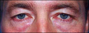 Blepharoplasty Before & After Patient #2453