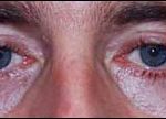 Blepharoplasty Before & After Patient #2453