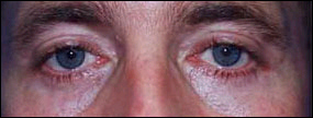 Blepharoplasty Before & After Patient #2453